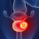 bladder-cancer