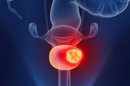 bladder-cancer