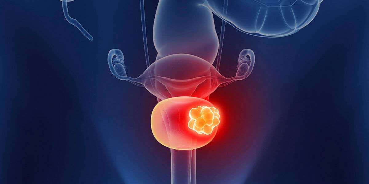 bladder-cancer