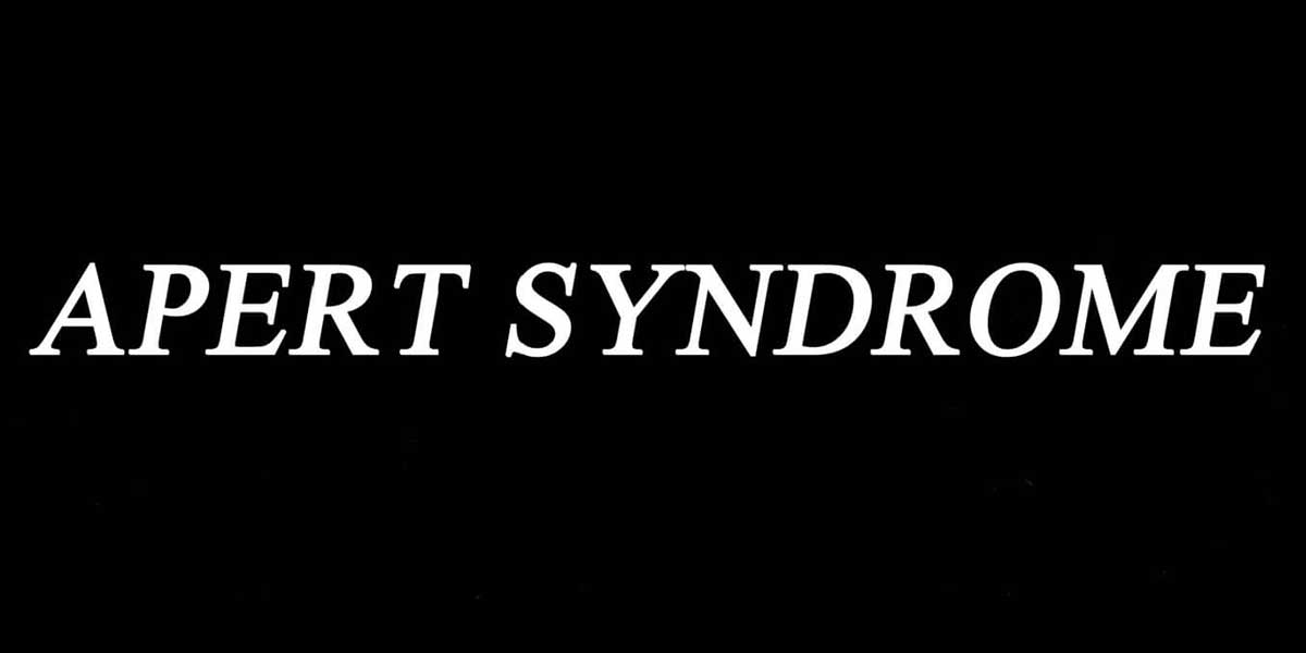 apert_syndrome