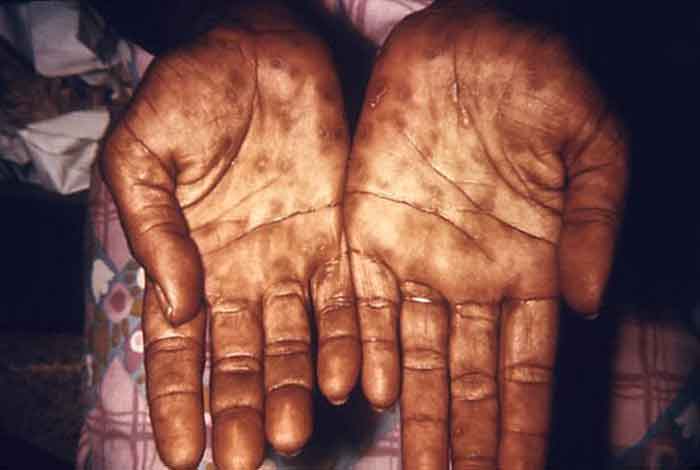 syphilis_secondary_hands