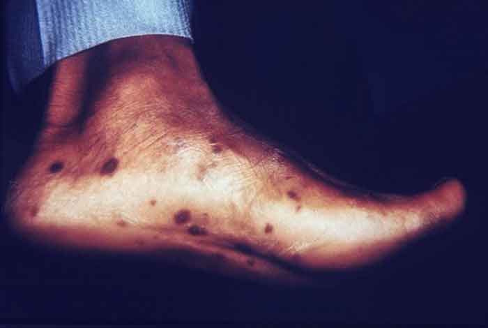 syphilis_secondary_sole